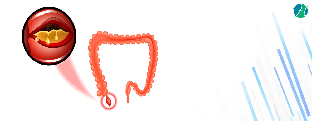 Appendectomy Indications and Risks General Surgery HealthSoul