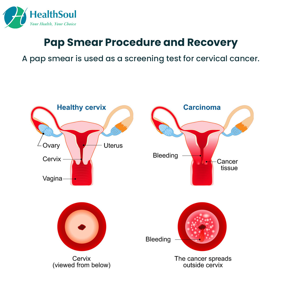 Purpose Of A Pap Smear Billing For Pap Smear SSMSR Purpose Of A Pap Smear Billing For Pap Smear SSMSR