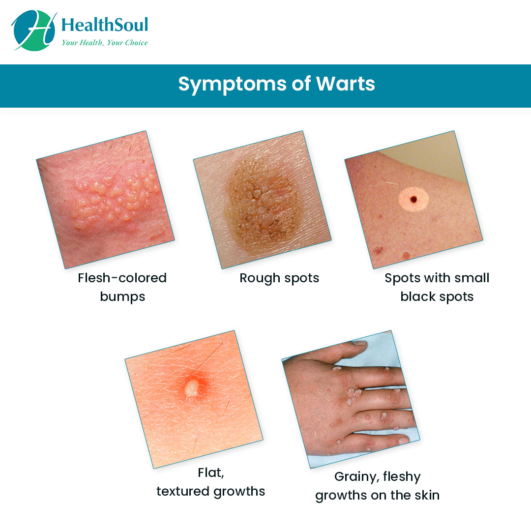 Warts