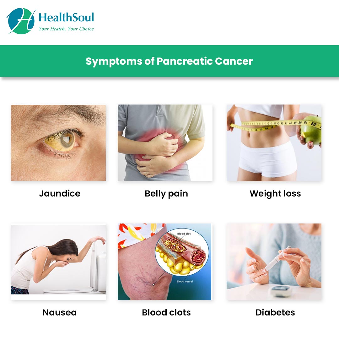 download diagnosing pancreatic cancer