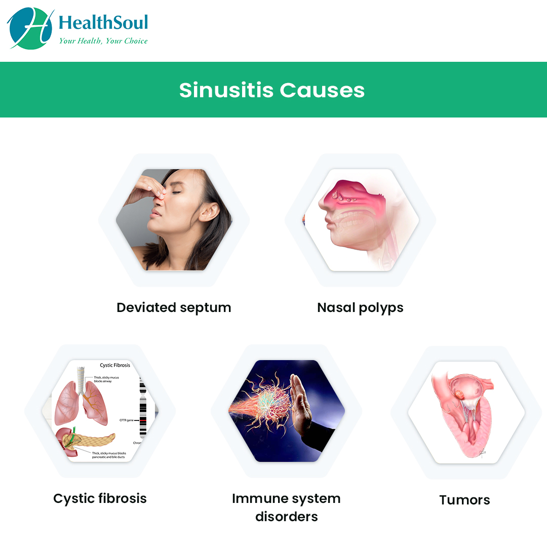Sinusitis Symptoms Causes Treatments Healthgrades