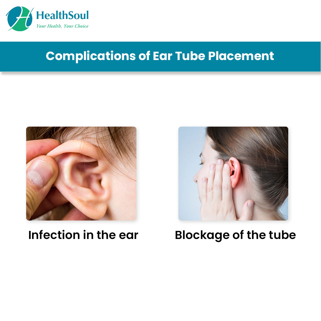 Ear Tube Placement Healthsoul