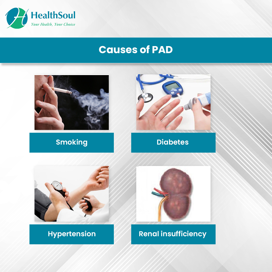 Peripheral Artery Disease Symptoms and Treatment Healthsoul