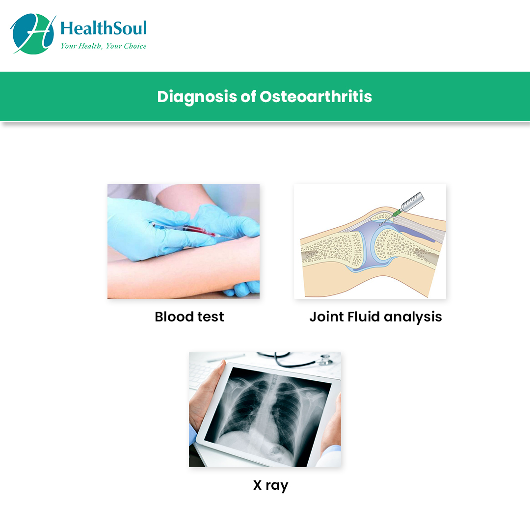 Diagnosis of osteoarthritis | HealthSoul