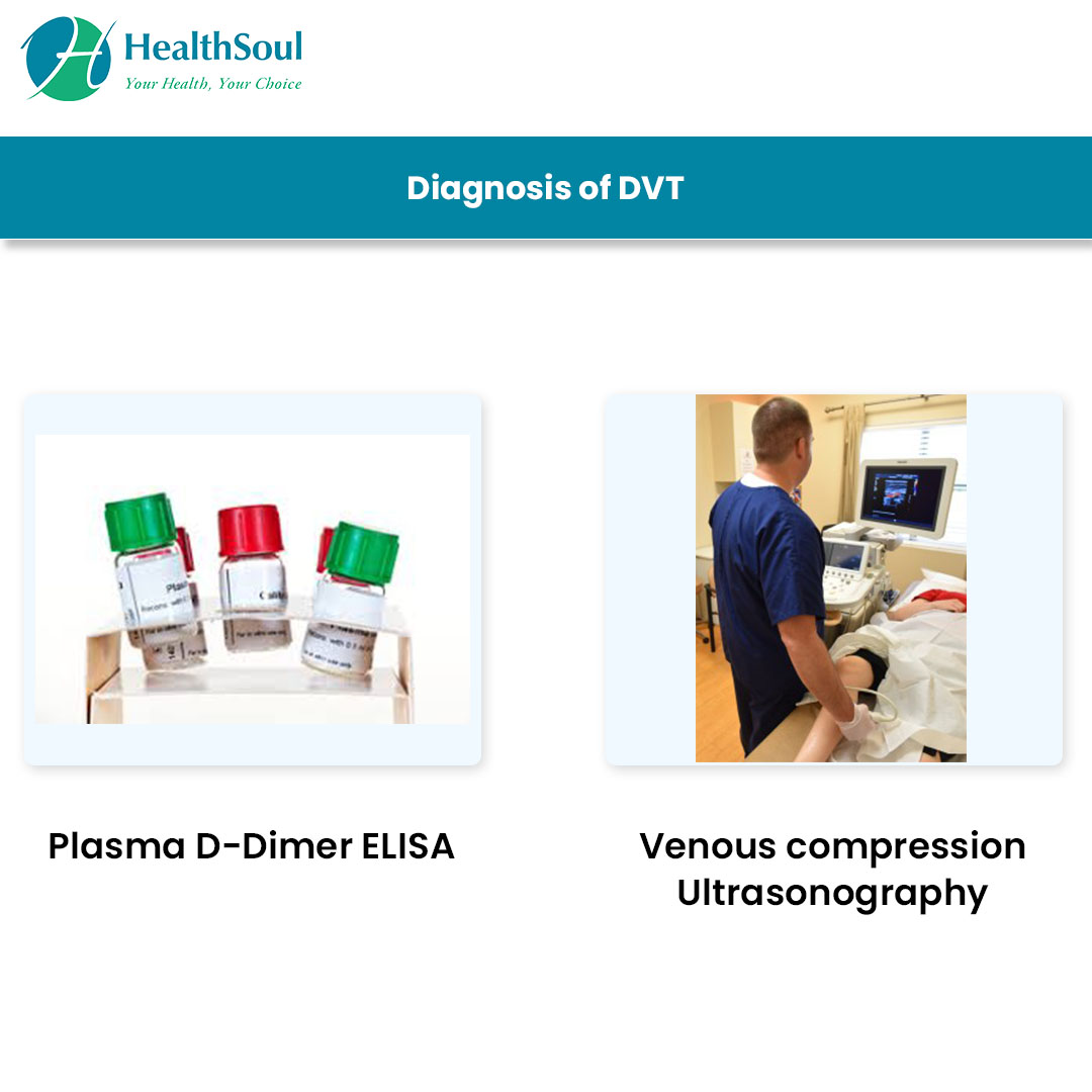 Test For Dvt How To Diagnose A Dvt : Deep vein thrombosis diagnosis: What to know ...