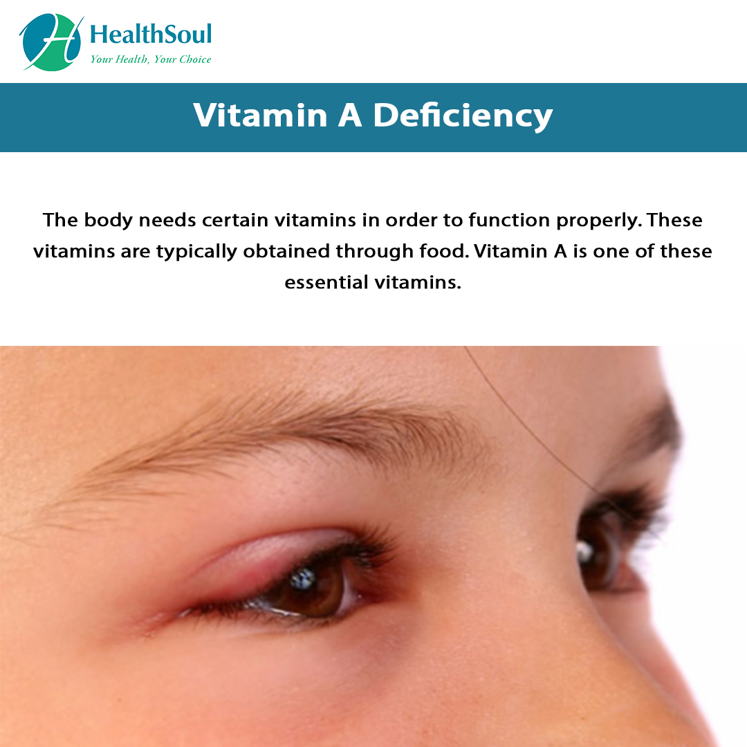 What Does The Deficiency Of Vitamin A Cause